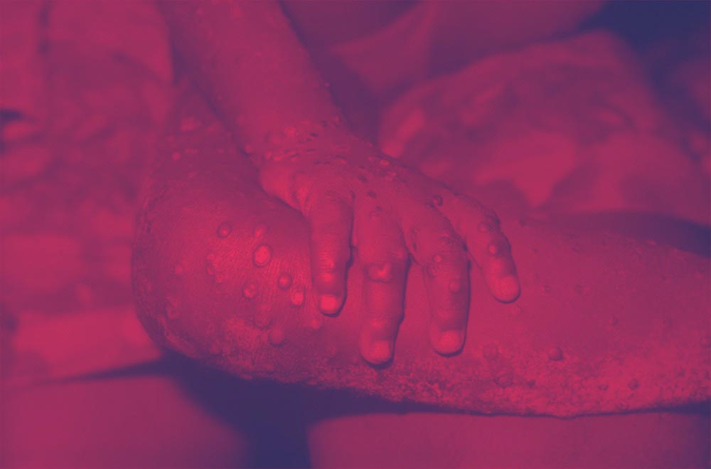 WHO-assisting-countries-hit-by-a-monkeypox-outbreak-in-Europe