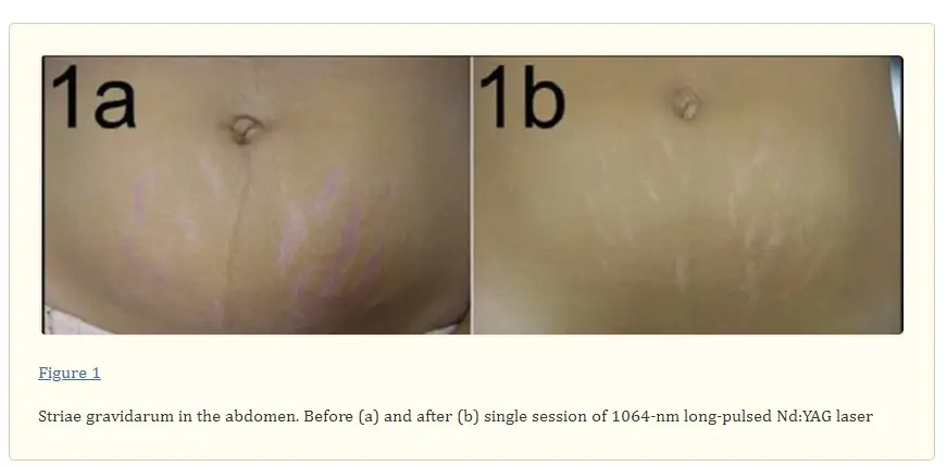 Image Source_ Pubmed(1)